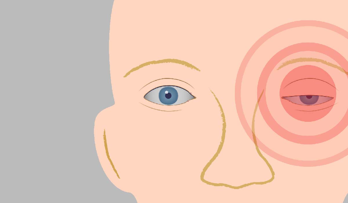 Editie Migraine Clusterhoofdpijn Editie Migraine Clusterhoofdpijn